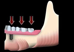 Wirkende Kaukräfte auf das Implantat