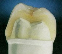 Die Zahnkronen verdecken Verfärbungen und andere Unregelmäßigkeiten an den Zähnen.