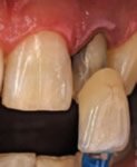 Insbesondere bei geschädigten Zähnen im Frontzahnbereich bieten sich Zahnkronen aus Vollkeramik an, um natürliche Zähne bestmöglich nachzubilden.