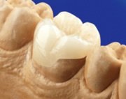 Keramik Teilkrone auf Zahnmodell
