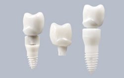 Zahnimplantate eignen sich sehr gut zur Zahnlückenversorgung.