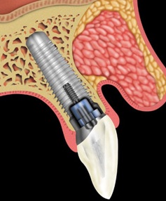Implantat in schematischer Darstellung