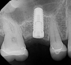 Implantat im einzeitigen Verfahren.