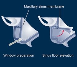 Der Sinuslift kann bei der Anpassung des Kiefers genutzt werden, um Implantate richtig eintzusetzen.