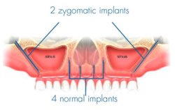 Spezielle KIPP-Implantate vermieden werden.