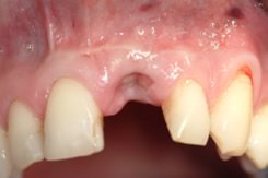 Implantate können vom erfahrenen Zahnarzt an nahezu jeder beliebigen Stelle der Zahnreihe eingepasst werden.