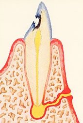 Fistelgang an der Zahnwurzel
