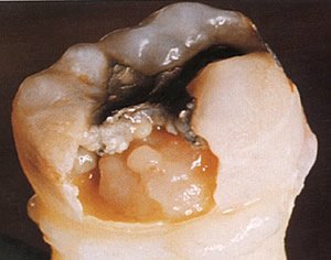 Karies stellt die häufigste Ursache für Zahnschmerzen dar