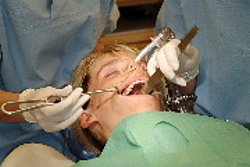 Bei größeren Zahnsanierungen bietet sich die Behandlung unter Narkose an.