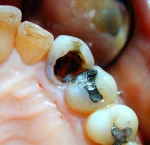 Zieht sich die Karies bis in die Wurzelspitzen, können Bakterien oder Chemikalien eindringen und zur Entzundung führen. Ohne Behandlung kann dies zum Zahnverkust führen.