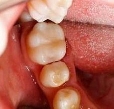 Künstlicher Zahnzement kann vielfältig verwendet werden. So eignet er sich nicht nur als provisorische Zahnfüllung, sondern auch zur Befestigung von Zahnbrücken, Zahnkronen oder Inlays.